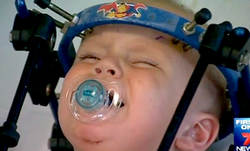 پیوند سر کودک ۱۶ ماهه ! رویداد مهم پزشکی + عکس پیوند سر young jackson